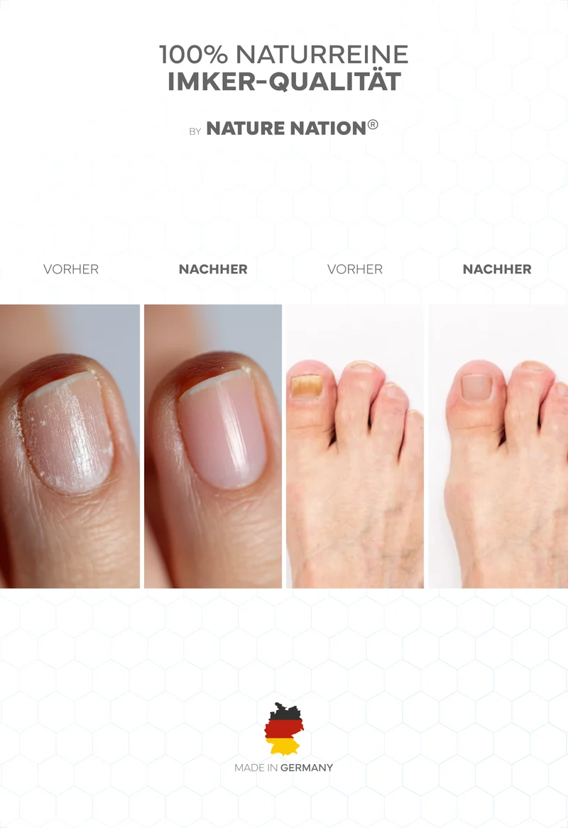 Propolis Nagelserum, 10ml - Akutpflege bei Nagelpilz, mit hochdosiertem Bio-Propolisextrakt sowie Teebaumöl, Zink, Selen & Biotin, für gesunde & starke Nägel, mit gratis Propolis-Seife